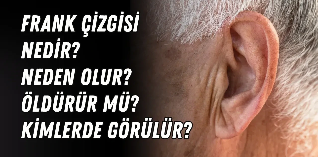 Frank Çizgisi Nedir, Neden Olur? Öldürür Mü, Kimlerde Görülür