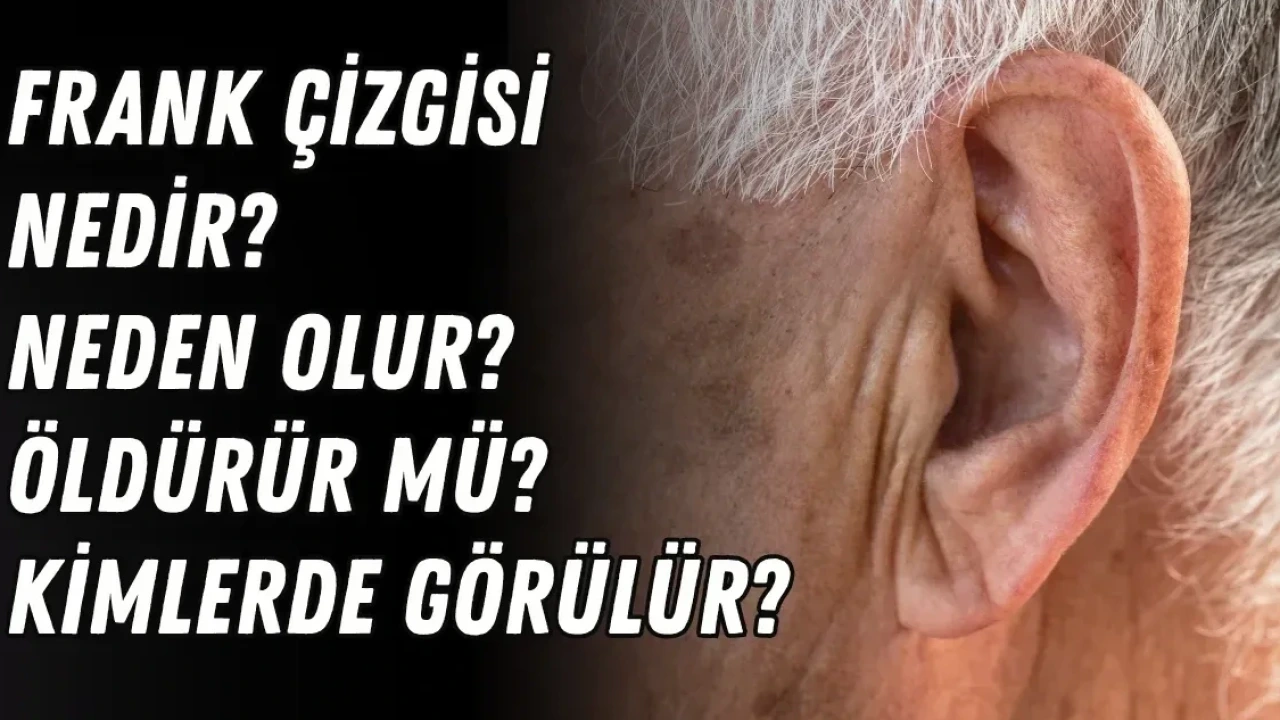 Frank Çizgisi Nedir, Neden Olur? Öldürür Mü, Kimlerde Görülür - Antalya Haber